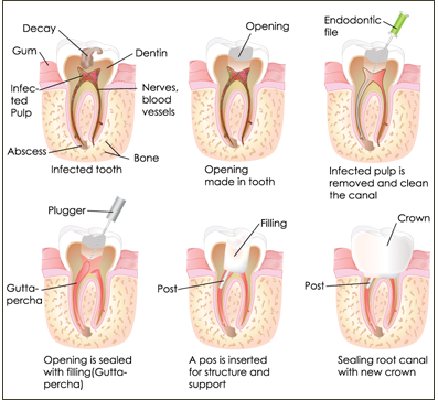 root canals pendleton oregon