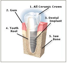 implant placement pendleton oregon